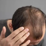 37歲男髮線後退以為雄性禿 抽血才發現「鋅不足」惹禍
