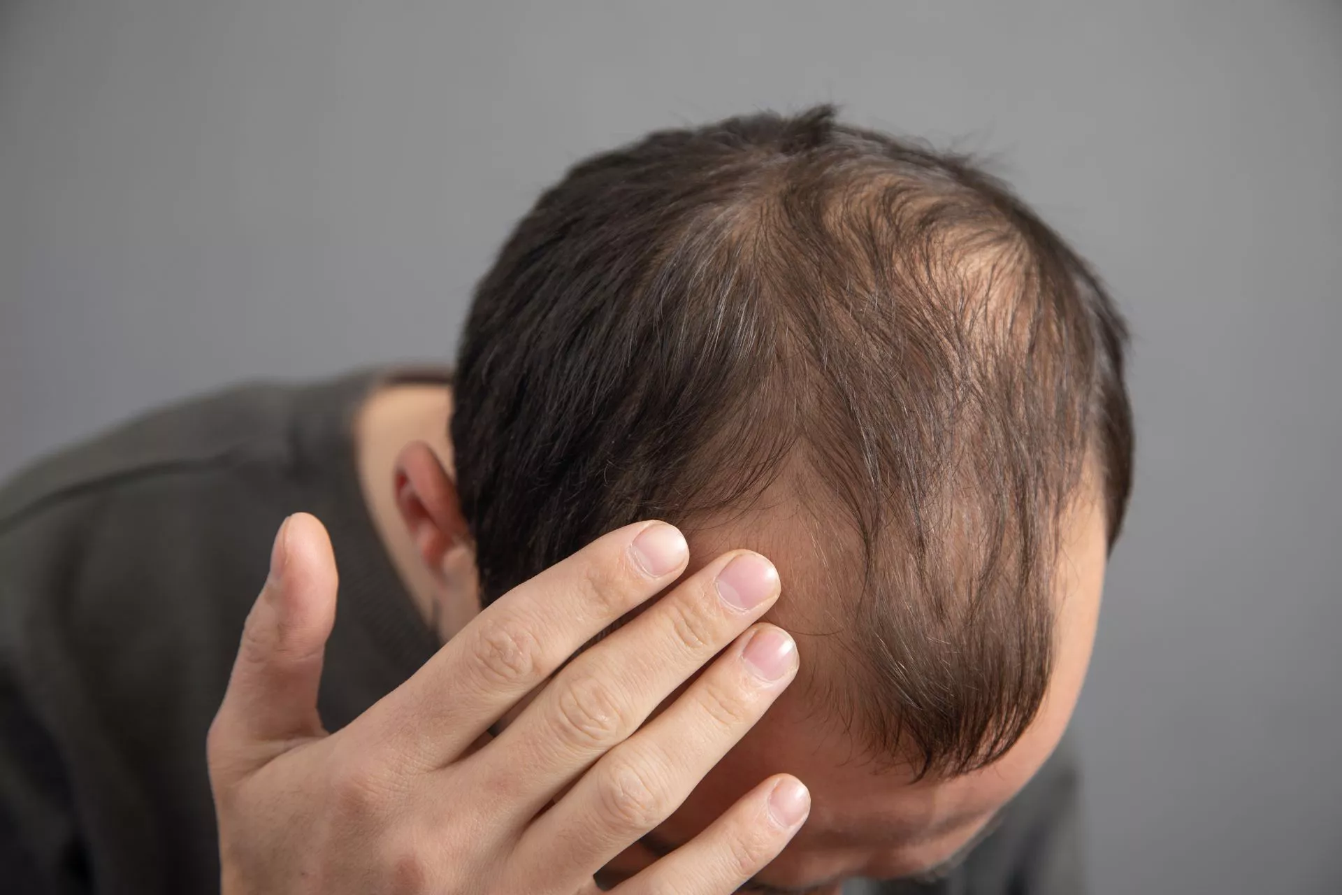 37歲男髮線後退以為雄性禿 抽血才發現「鋅不足」惹禍