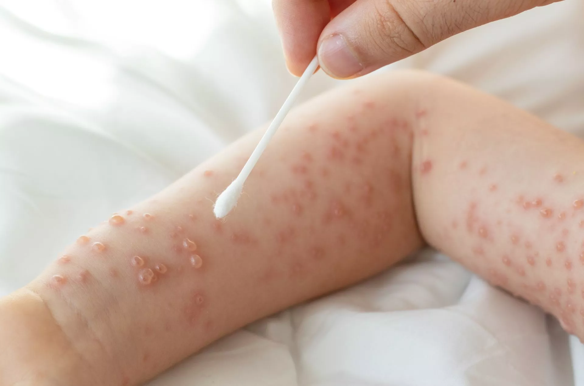 換季手腳冒出「西米露水泡」恐是汗皰疹 醫提醒4類食物少吃